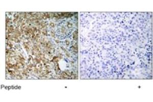 Immunohistochemical analysis of paraffin-embedded human breast carcinoma tissue using IGF1R polyclonal antibody  . (IGF1R 抗体)