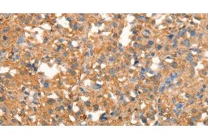 Immunohistochemistry of paraffin-embedded Human thyroid cancer using CRELD1 Polyclonal Antibody at dilution of 1:40 (CRELD1 抗体)