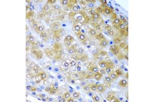 Immunohistochemistry of paraffin-embedded human liver cancer using BMF antibody (ABIN6290093) at dilution of 1:200 (40x lens). (BMF 抗体)