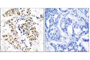 Immunohistochemical analysis of paraffin-embedded human breast carcinoma tissue using ATM (phospho-Ser1981) antibody (E011122). (ATM 抗体  (pSer1981))