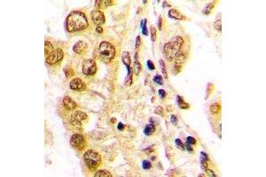 Immunohistochemical analysis of JUND staining in human lung cancer formalin fixed paraffin embedded tissue section. (JunD 抗体  (C-Term))