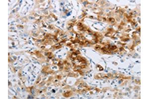 The image on the left is immunohistochemistry of paraffin-embedded Human lung cancer tissue using ABIN7191702(NPY2R Antibody) at dilution 1/20, on the right is treated with synthetic peptide. (NPY2R 抗体)