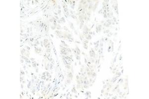 ABIN6263882 and ABIN6272765 at 1/100 staining human lung squamous cell carcinoma by IHC-P.