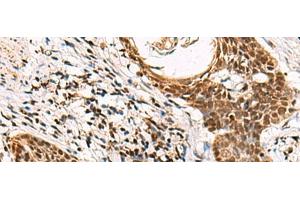 Immunohistochemistry of paraffin-embedded Human esophagus cancer tissue using GABPB1 Polyclonal Antibody at dilution of 1:70(x200)