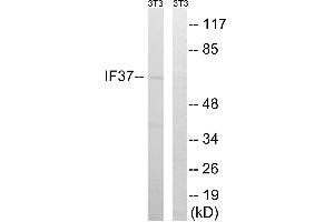 Immunohistochemistry analysis of paraffin-embedded human breast carcinoma tissue using EIF3D antibody. (EIF3D 抗体  (Internal Region))