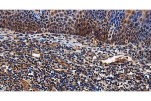 Immunohistochemistry of paraffin-embedded Human tonsil tissue using LRRC57 Polyclonal Antibody at dilution 1:40 (LRRC57 抗体)