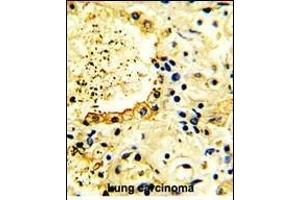 Immunohistochemistry (Paraffin-embedded Sections) (IHC (p)) image for anti-tyrosine Kinase, Non-Receptor, 2 (TNK2) (AA 10-39), (N-Term) antibody (ABIN392082)