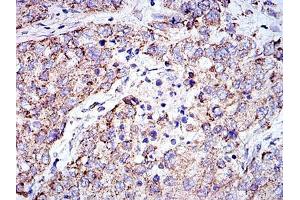 Immunohistochemical analysis of paraffin-embedded lung cancer tissues using PHB mouse mAb with DAB staining.