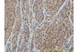 Immunoperoxidase of monoclonal antibody to RHOA on formalin-fixed paraffin-embedded human lymphoma tissue. (RHOA 抗体  (AA 1-193))