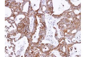 IHC-P Image Immunohistochemical analysis of paraffin-embedded NCIN87 xenograft , using PANK1, antibody at 1:500 dilution. (PANK1 抗体)