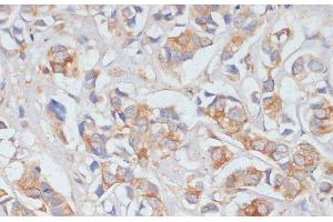 Immunohistochemistry of paraffin-embedded Human breast cancer using DLL1 Polyclonal Antibody at dilution of 1:100 (40x lens). (DLL1 抗体)