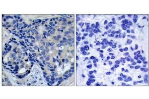 Immunohistochemical analysis of paraffin-embedded human breast carcinoma tissue, using Pyk2 (phospho-Tyr402) antibody (E011216). (PTK2B 抗体  (pTyr402))