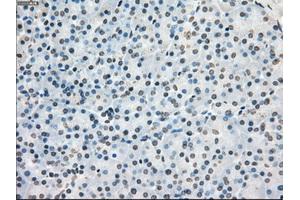 Immunohistochemical staining of paraffin-embedded Adenocarcinoma of colon tissue using anti-PORmouse monoclonal antibody. (POR 抗体)