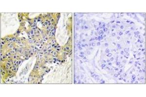 Immunohistochemistry analysis of paraffin-embedded human breast carcinoma tissue, using IARS2 Antibody. (IARS2 抗体  (AA 71-120))