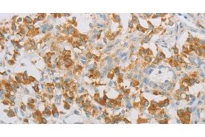 Immunohistochemistry of paraffin-embedded Human thyroid cancer tissue using REN Polyclonal Antibody at dilution 1:40 (Renin 抗体)