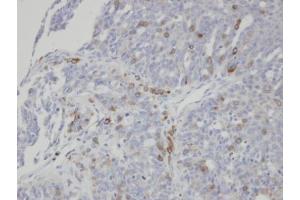 IHC-P Image Immunohistochemical analysis of paraffin-embedded human serous ovarian cancer, using ST3GAL1, antibody at 1:100 dilution. (ST3GAL1 抗体)