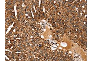 The image on the left is immunohistochemistry of paraffin-embedded Human breast cancer tissue using ABIN7129957(KCNH6 Antibody) at dilution 1/30, on the right is treated with fusion protein.
