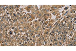 Immunohistochemistry of paraffin-embedded Human lung cancer using MYL3 Polyclonal Antibody at dilution of 1:45 (MYL3/CMLC1 抗体)