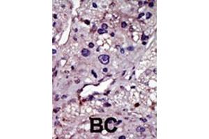 Formalin-fixed and paraffin-embedded human cancer tissue reacted with the primary antibody, which was peroxidase-conjugated to the secondary antibody, followed by AEC staining. (UCK 抗体  (N-Term))