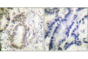 Immunohistochemistry analysis of paraffin-embedded human lung carcinoma, using C/EBP-alpha (Phospho-Ser21) Antibody.