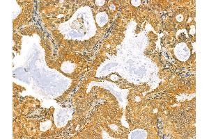 ABIN6264681 and ABIN6273070 at 1/100 staining Human lung cancer by IHC-P. (RCN2 抗体  (C-Term))