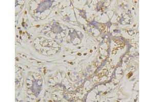 Immunohistochemistry of paraffin-embedded human mammary cancer using SLC2A1 antibody (ABIN5997113) at dilution of 1/100 (40x lens). (GLUT1 抗体)