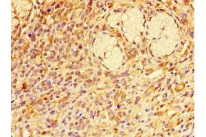 Immunohistochemistry of paraffin-embedded human gastric cancer using ABIN7167377 at dilution of 1:100 (RAB7A 抗体  (AA 110-177))