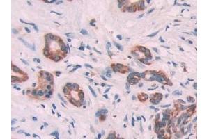 Detection of KRT6C in Human Pancreatic cancer Tissue using Polyclonal Antibody to Keratin 6C (KRT6C) (Keratin 6C 抗体  (AA 163-482))