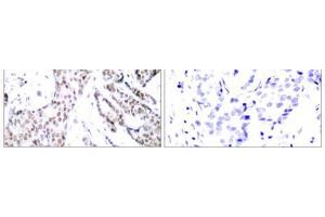Immunohistochemical analysis of paraffin- embedded human breast carcinoma tissue using STAT3 (phospho-Ser727) antibody (E011046). (STAT3 抗体  (pSer727))