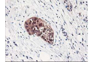 Immunohistochemical staining of paraffin-embedded Adenocarcinoma of Human breast tissue using anti-NIF3L1 mouse monoclonal antibody. (NIF3L1 抗体)