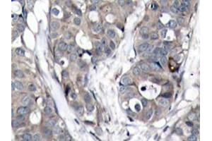 Immunohistochemistry analyzes of HSP27 antibody in paraffin-embedded human breast carcinoma tissue. (HSP27 抗体)