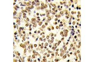 IHC analysis of FFPE human kideny carcinoma tissue stained with ERK5 antibody (MAPK7 抗体  (AA 776-805))