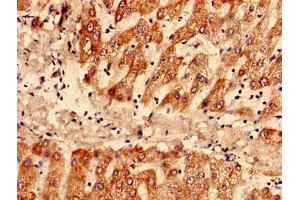 Immunohistochemistry analysis of human liver tissue using ABIN7169364 at dilution of 1:100 (SAA1 抗体  (AA 20-122))