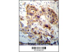 PI15 Antibody immunohistochemistry analysis in formalin fixed and paraffin embedded human breast carcinoma followed by peroxidase conjugation of the secondary antibody and DAB staining. (PI15 抗体  (N-Term))
