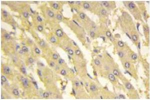 Immunohistochemistry: PFK-2 liv antibody staining of Paraffin-Embedded Human liver carcinoma tissue. (PFKFB1 抗体)