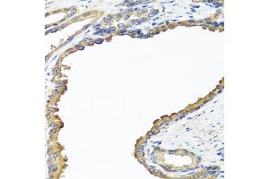 Immunohistochemistry of paraffin-embedded human prostate using NYX antibody. (Nyctalopin 抗体)
