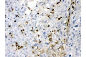 IHC testing of FFPE human liver cancer tissue with CA2 antibody at 1ug/ml. (CA2 抗体)