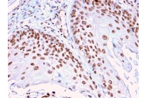 Formalin-fixed, paraffin-embedded human Cervical Carcinoma stained with CLEC9A Mouse Monoclonal Antibody (2H12/4). (DMC1 抗体)