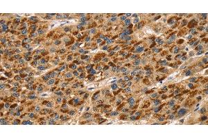 Immunohistochemistry of paraffin-embedded Human liver cancer using TLN1 Polyclonal Antibody at dilution of 1:30 (TLN1 抗体)