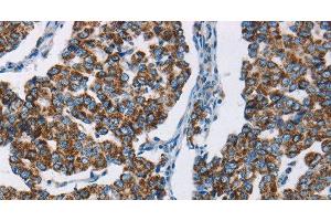 Immunohistochemistry of paraffin-embedded Human breast cancer using HINT2 Polyclonal Antibody at dilution of 1:50 (HINT2 抗体)
