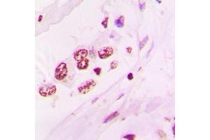 Immunohistochemical analysis of NR2F6 staining in human lung cancer formalin fixed paraffin embedded tissue section.
