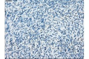 Immunohistochemical staining of paraffin-embedded Adenocarcinoma of breast tissue using anti-PRKAR1A mouse monoclonal antibody. (PRKAR1A 抗体)