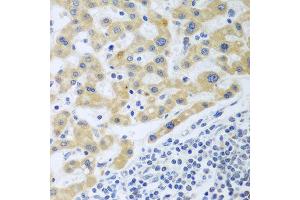 Immunohistochemistry of paraffin-embedded human liver cancer using SHBG antibody at dilution of 1:100 (40x lens). (SHBG 抗体)