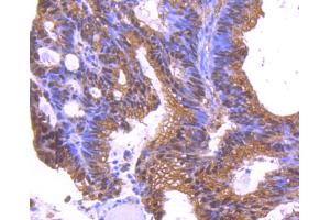 Paraformaldehyde-fixed, paraffin embedded human colon cancer, Antigen retrieval by boiling in sodium citrate buffer (pH6. (YWHAE 抗体)