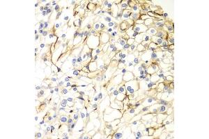 Immunohistochemistry of paraffin-embedded human kidney cancer using V antibody (ABIN6132779, ABIN6150054, ABIN6150055 and ABIN6223794) at dilution of 1:100 (40x lens).