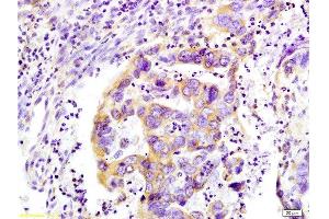 Formalin-fixed and paraffin-embedded : human colon carcinoma labeled with Rabbit Anti-WNK3 protein Polyclonal Antibody , Unconjugated 1:200 followed by conjugation to the secondary antibody (WNK3 抗体  (AA 451-550))