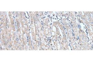 Immunohistochemistry of paraffin-embedded Human gastric cancer tissue using SPTA1 Polyclonal Antibody at dilution of 1:80(x200) (SPTA1 抗体)