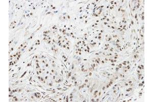 IHC-P Image Immunohistochemical analysis of paraffin-embedded A549 xenograft, using SPHK1, antibody at 1:100 dilution. (SPHK1 抗体  (C-Term))