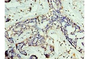 Immunohistochemistry of paraffin-embedded human breast cancer using ABIN7153848 at dilution of 1:100 (GAN 抗体  (AA 1-240))