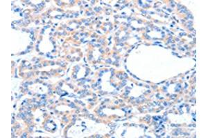The image on the left is immunohistochemistry of paraffin-embedded Human thyroid cancer tissue using ABIN7128170(ACOX1 Antibody) at dilution 1/20, on the right is treated with fusion protein. (ACOX1 抗体)